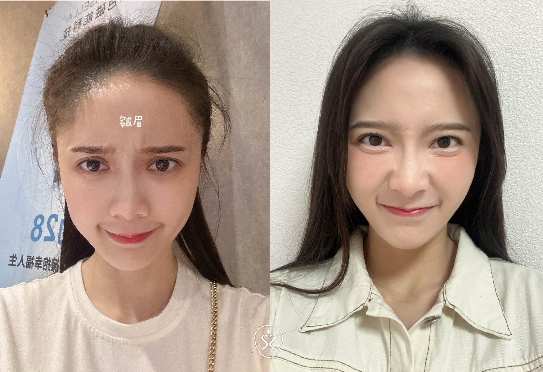 【肉毒除皺】